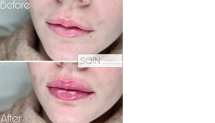 SCIN-lips