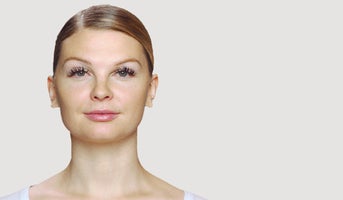 Se resultat efter injektion med Restylane-fillers